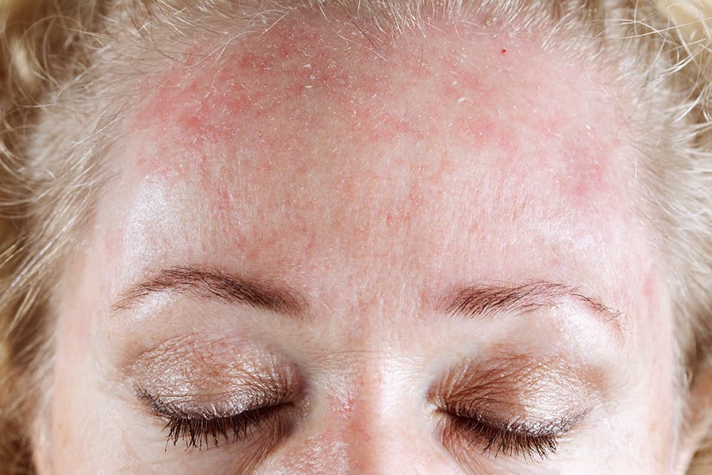 Seborrheic Dermatitis (Flaky/itchy skin)