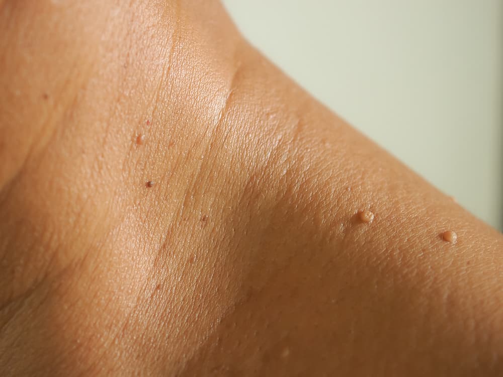 Skin Tags Removal