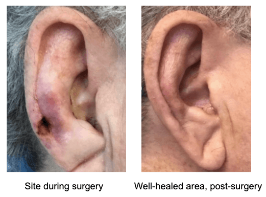 Basal cell carcinoma on the ear