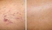 Broken Capillaries & Dilated Blood Vessels