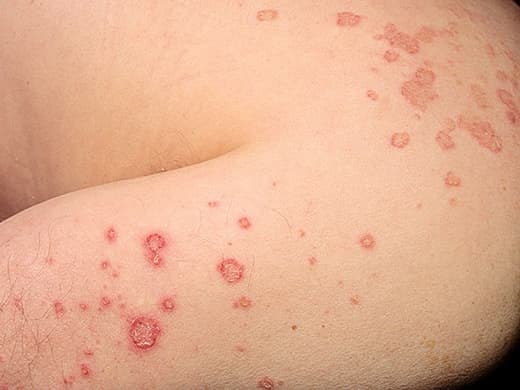 Eczema-Atopic-Dermatitis-030