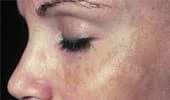 Hyperpigmentation & Melasma
