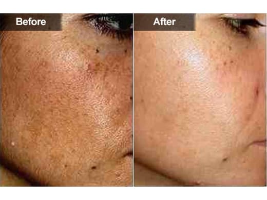 Hyperpigmentation-Melasma-050