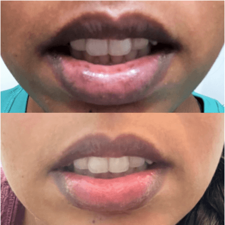 Lip Lightening