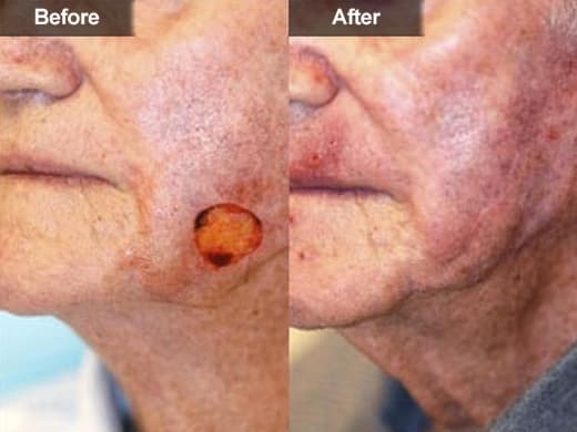 Mohs Surgery clinical photo