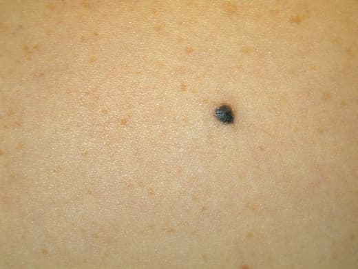 Moles, Atypical Moles & Melanoma clinical photo