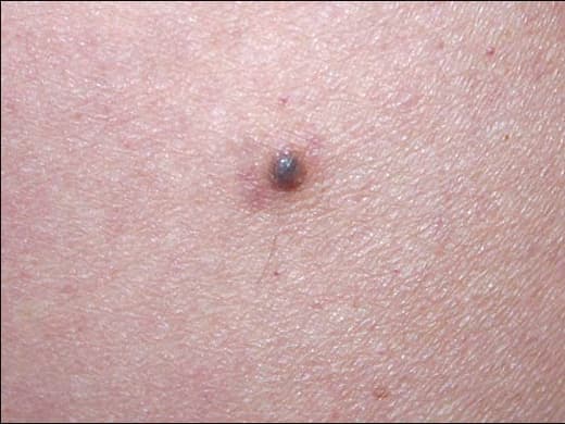 Moles, Atypical Moles & Melanoma clinical photo