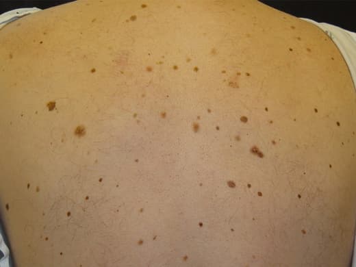 Moles, Atypical Moles & Melanoma clinical photo