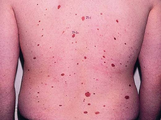 Moles, Atypical Moles & Melanoma clinical photo