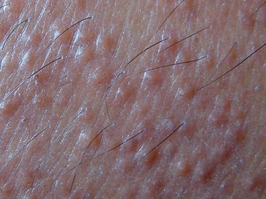 Rashes clinical photo