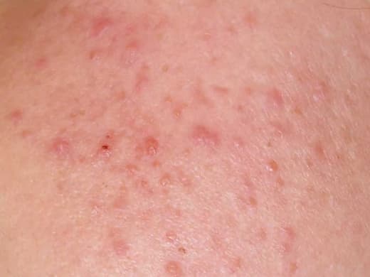 Rosacea Specialist clinical photo