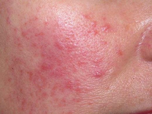 Rosacea Specialist clinical photo