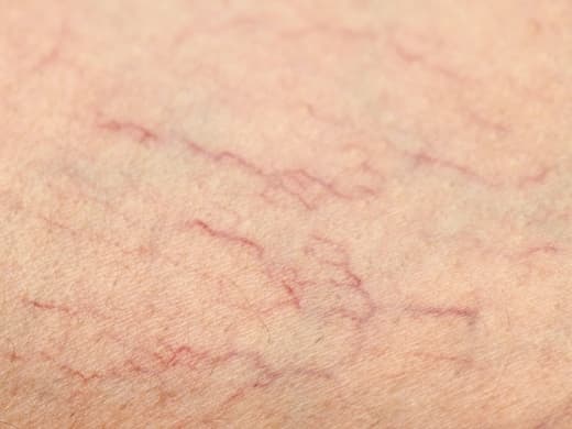 Spider Veins clinical photo