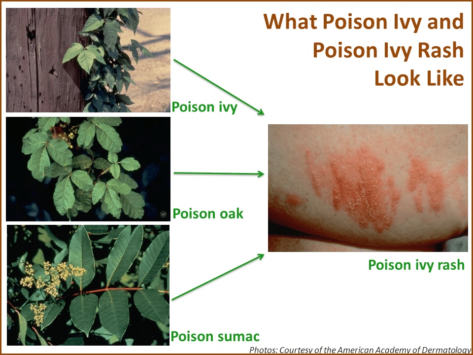 Comparison of poison ivy, poison oak, poison sumac, and a poison ivy rash