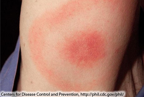 Circular red rash associated with a tick bite
