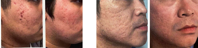 Acne Scarring Treatment