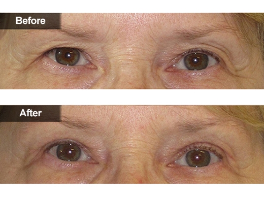 Blepharoplasty Eyelid Surgery clinical photo