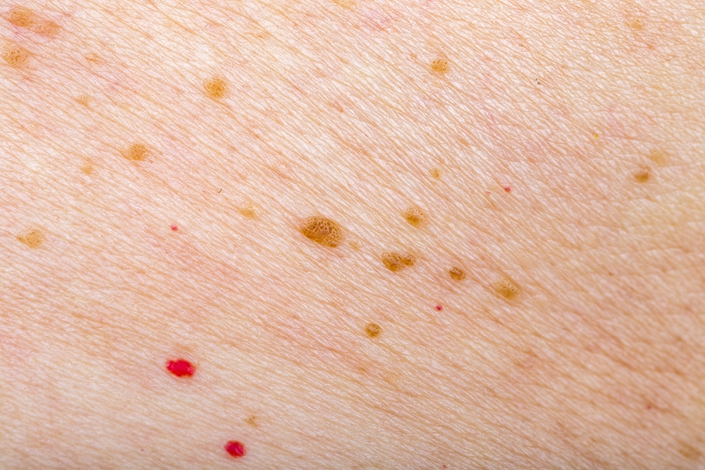 Cherry Angiomas