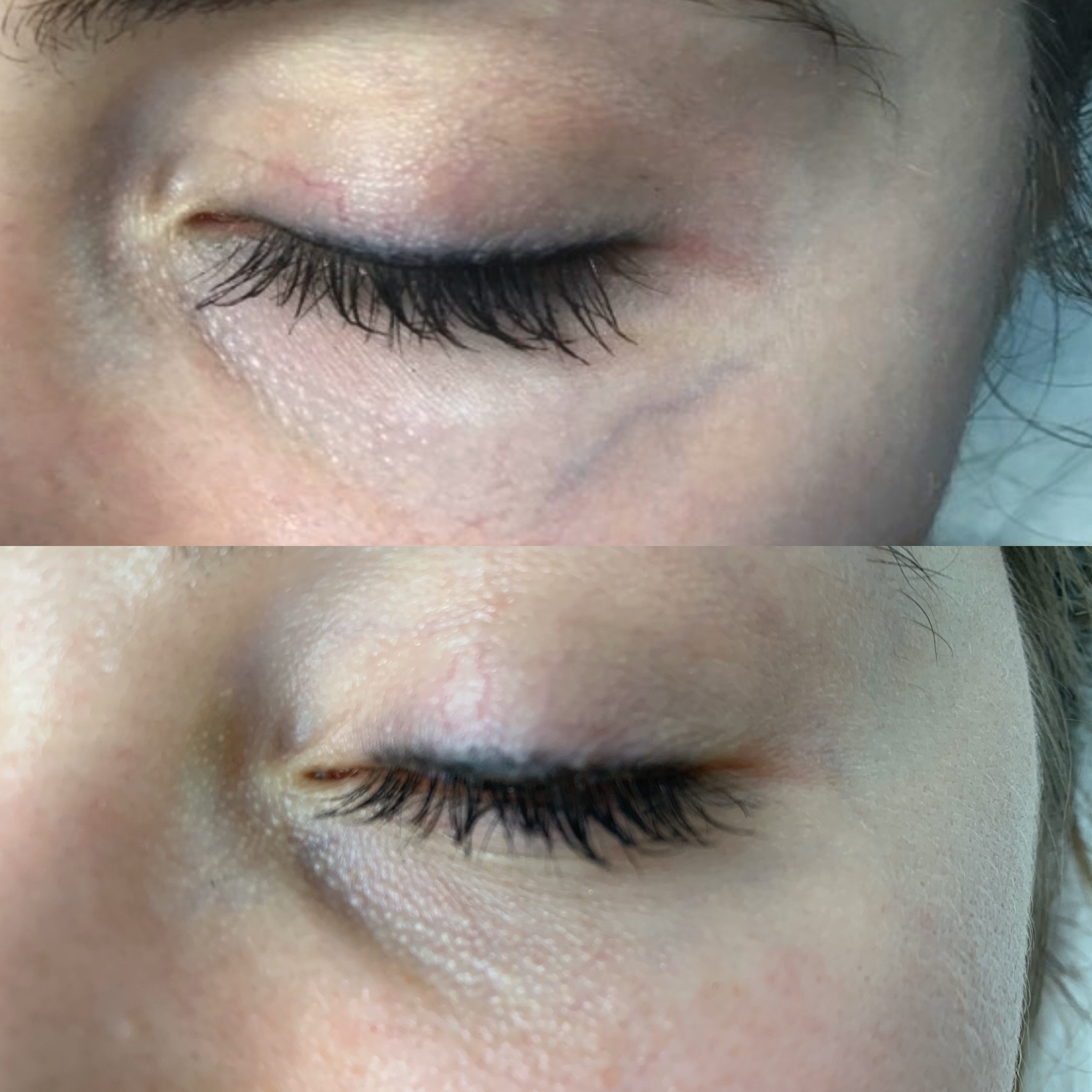 Facial Veins Removal