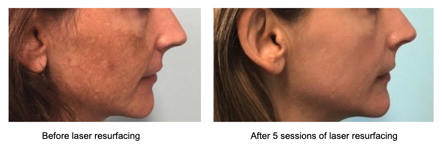 Hyperpigmentation