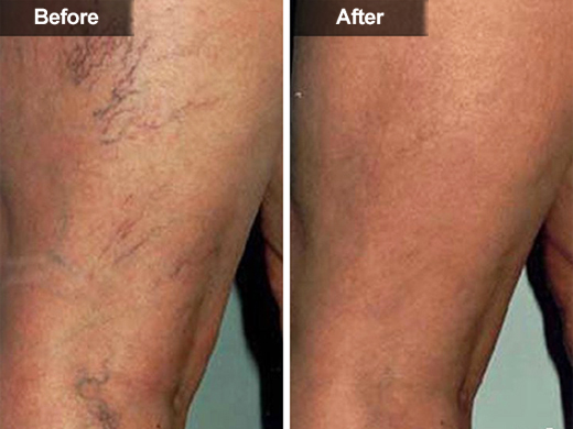 Sclerotherapy (Leg Vein Treatment) clinical photo