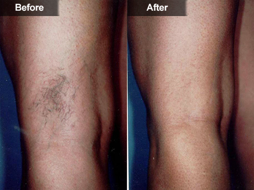 Sclerotherapy (Leg Vein Treatment) clinical photo