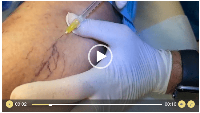 Sclerotherapy (Leg Vein Treatment)
