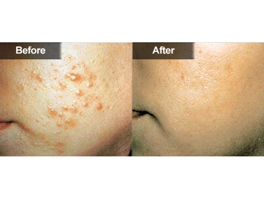 Microdermabrasion / Power Peels® clinical photo