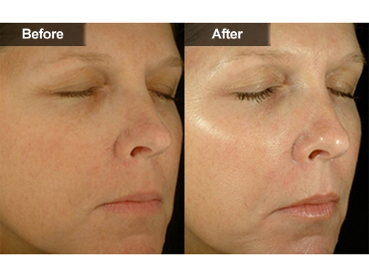 Microdermabrasion / Power Peels® clinical photo