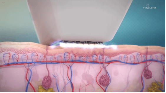 Microneedling & Skin Resurfacing - Venus Viva