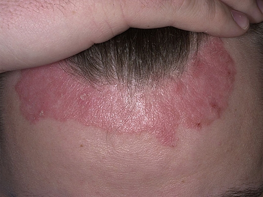 Psoriasis clinical photo