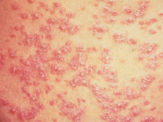 Psoriasis clinical photo