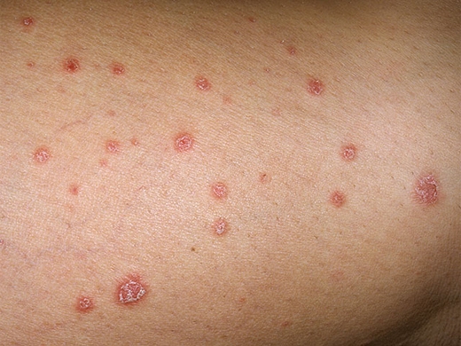 Psoriasis clinical photo