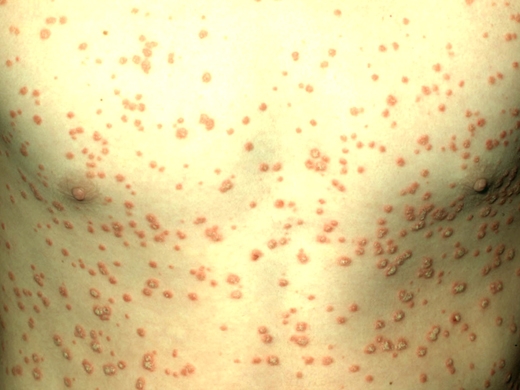 Psoriasis clinical photo