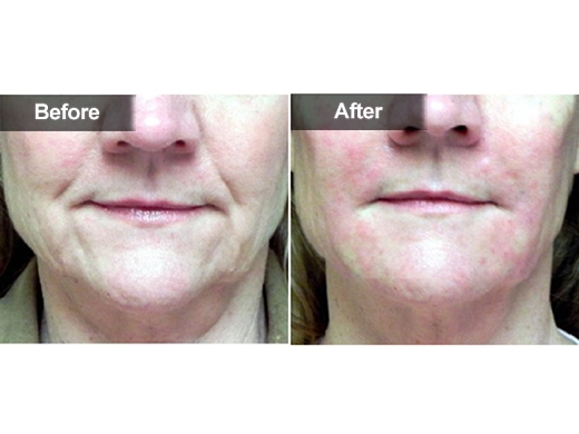Radiesse® clinical photo