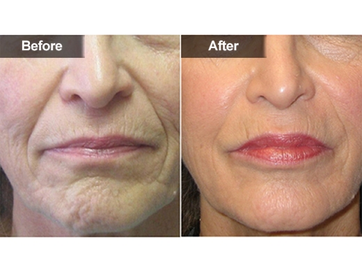 Radiesse® clinical photo
