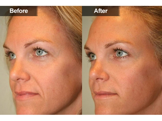 Radiesse® clinical photo