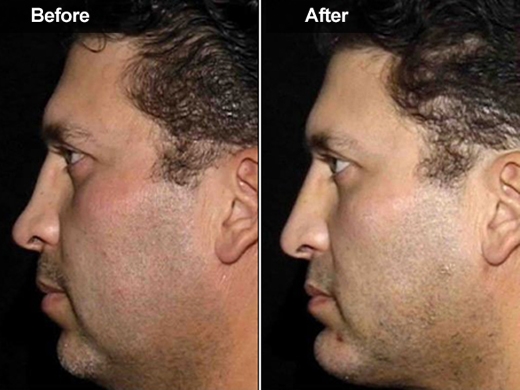 Radiesse® clinical photo