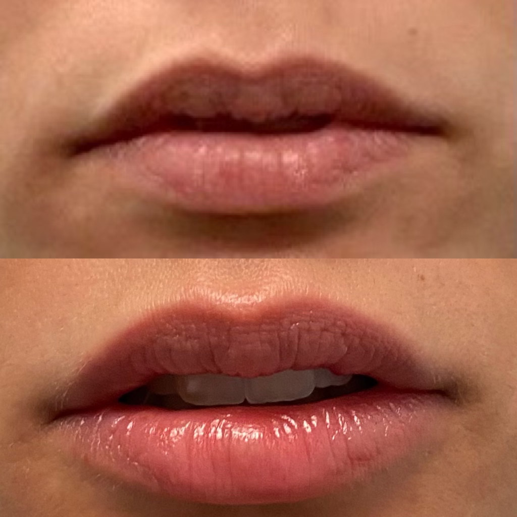 filler injections