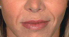 Restylane Lyft (formerly called "Perlane")