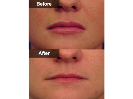 Restylane® clinical photo