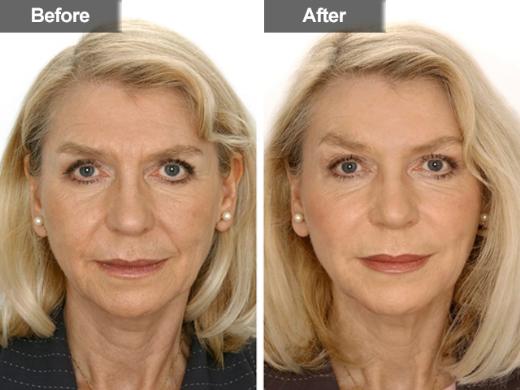 Restylane® clinical photo