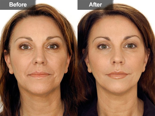 Restylane® clinical photo