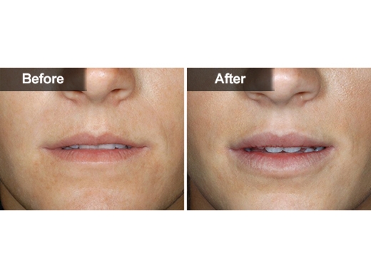 Restylane® clinical photo