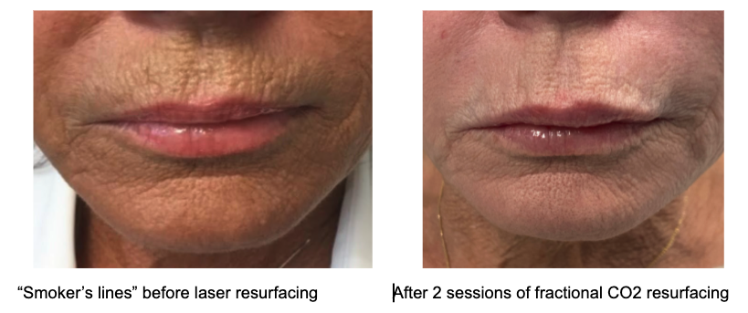Skin Laser Resurfacing