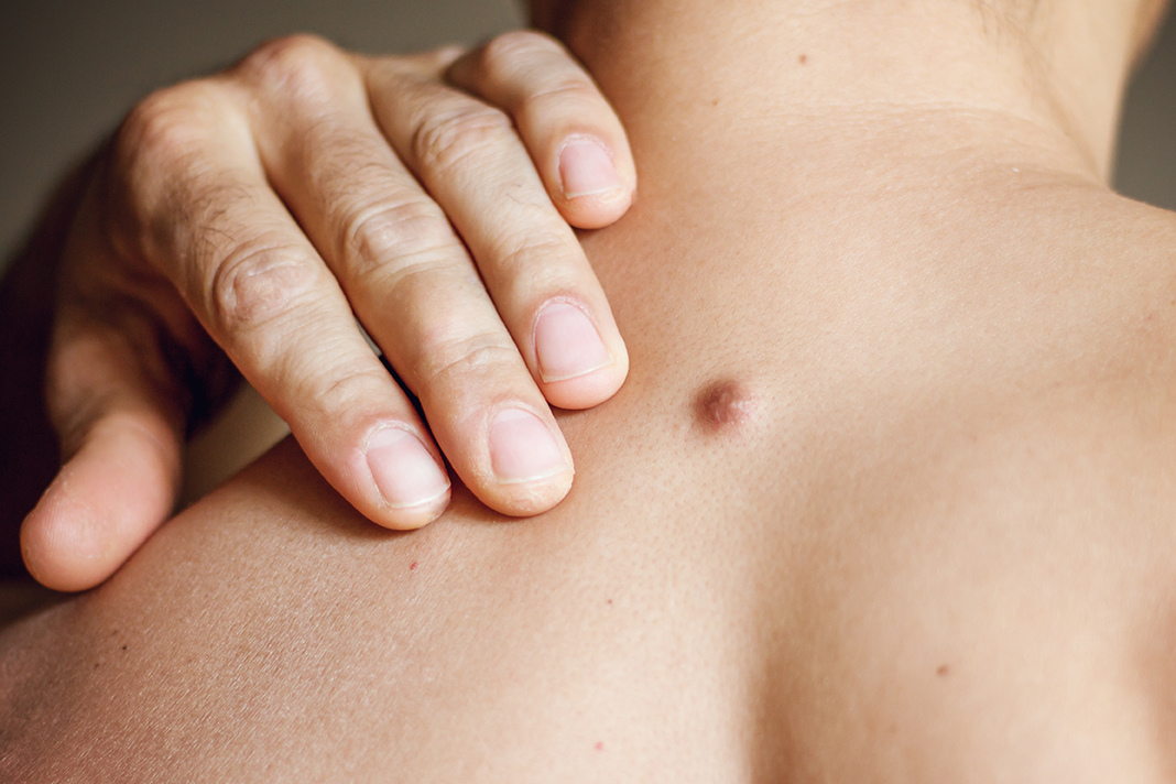 cyst removal