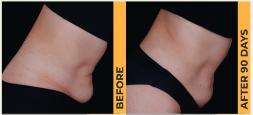 Ultherapy Prime Abs Treatment
