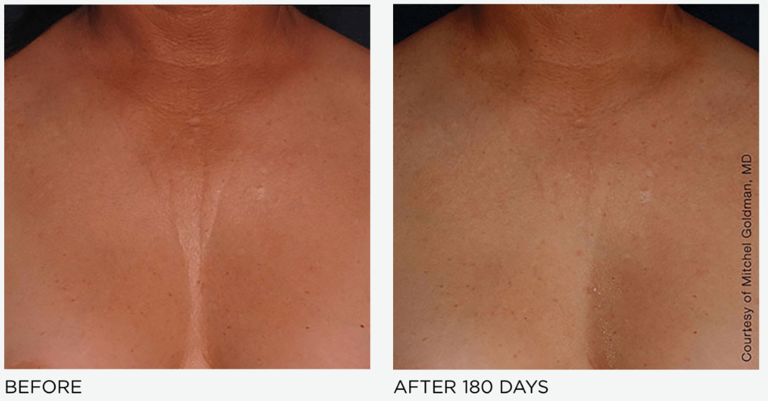 Ultherapy Prime Chest Treatment