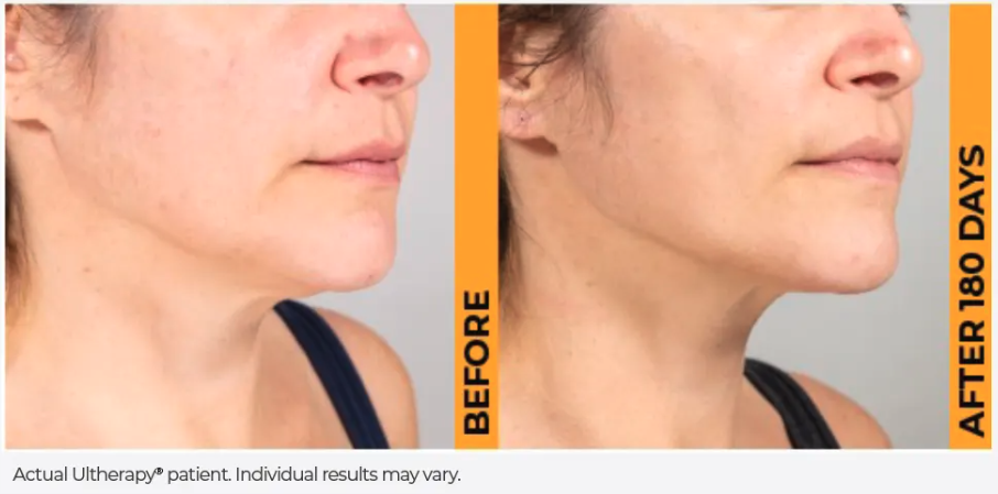 Ultherapy Prime Treatment