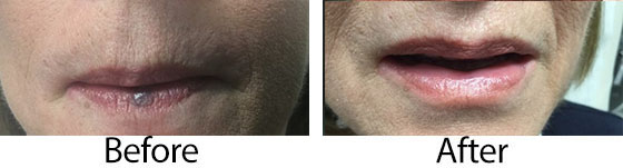 Venous Lake Treatment